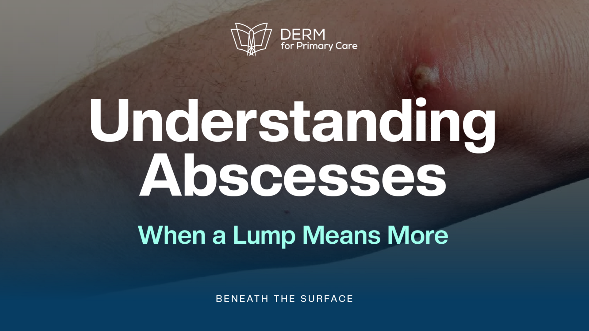 Abscesses Decoded: Clinical Insights for Prevention & Care