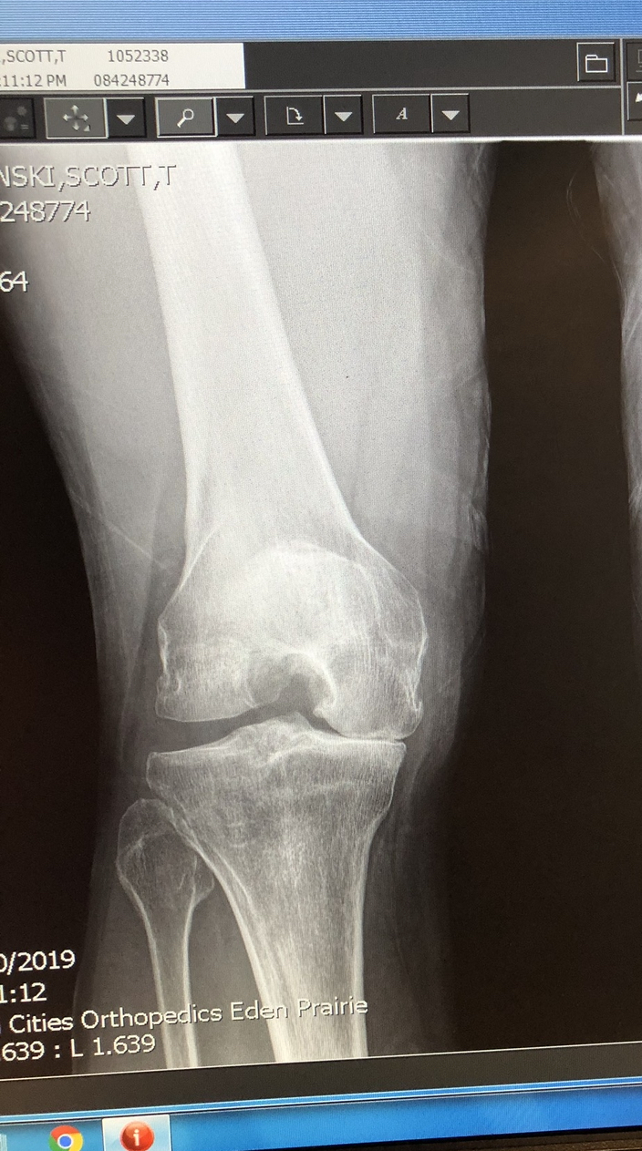 Three Surgeons. One Answer; How I Refused the Script and Wrote My Own