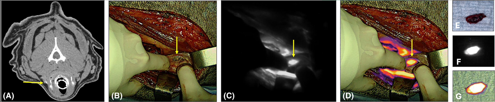 One more indication for sentinel lymph node mapping....