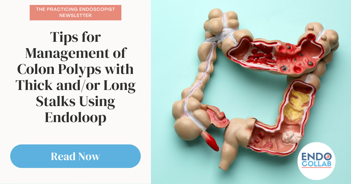 Tips for Management of Colon Polyps with Thick and/or Long Stalks Using Endoloop