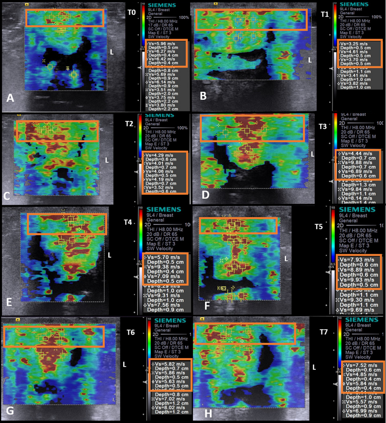 ARFI Elastography in Detecting Elasticity Changes in Equine Tendons