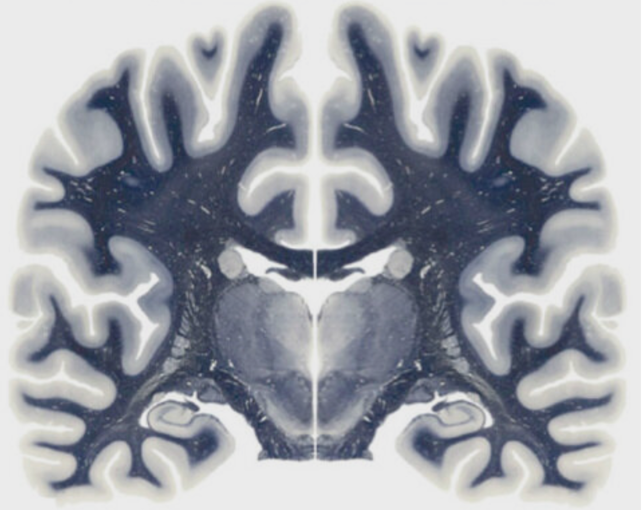 A cell therapy Curing Alzheimer's in dogs and people