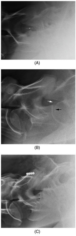 Warmbloods and C7-T2 - What can go wrong?