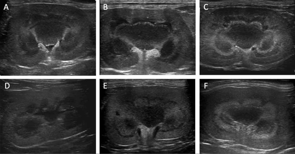 Should you care about a medullary rim sign?