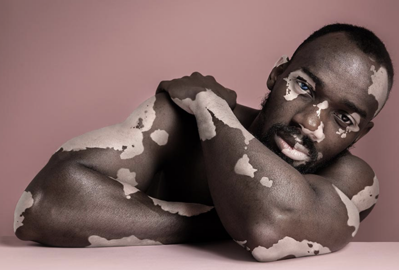 Um medicamento revolucionário para o Vitiligo