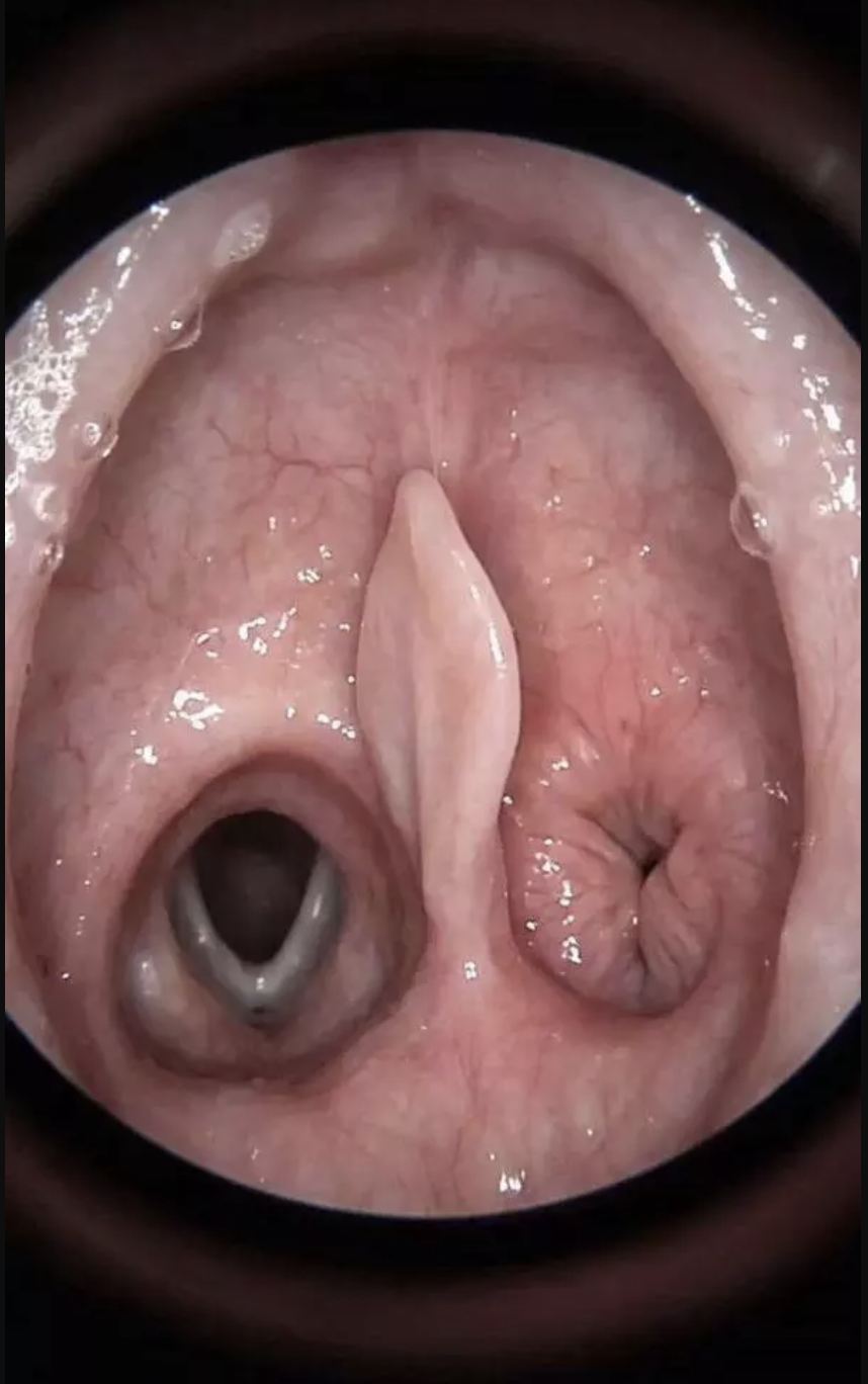 A dark, circular scope-style view inside a throat showing two openings and a leaf-shaped flap between them, with a timestamp in the corner, a still from an AI-generated video