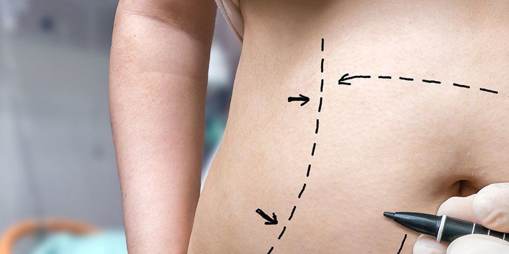 8 Questions to Ask a Liposuction Surgeon