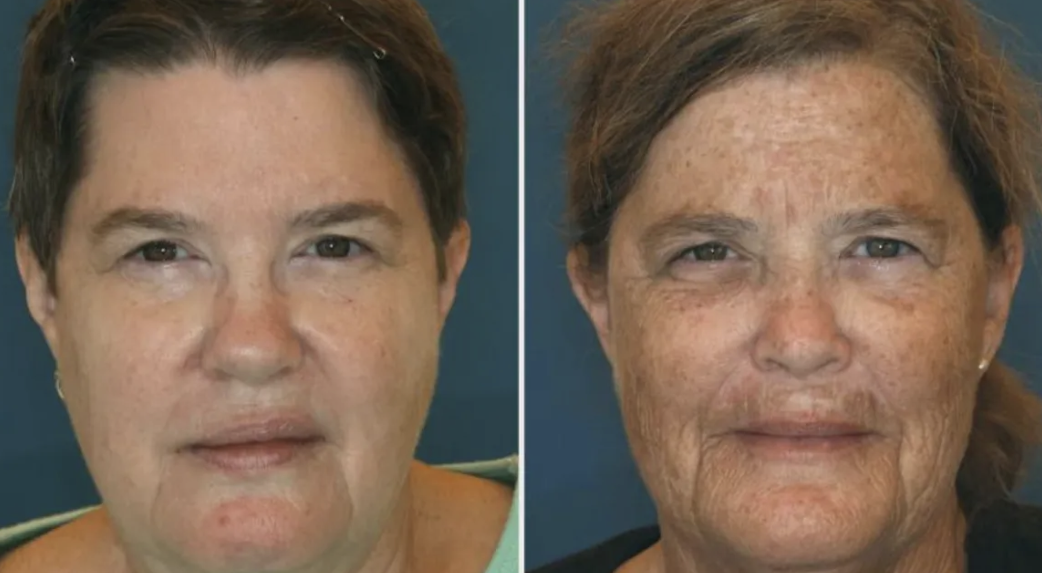 Two real identical-twin faces side by side with a peeling ‘she smoked for 16 years!’ caption the study never said