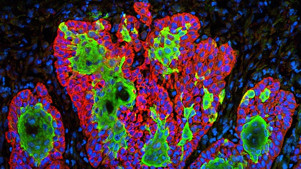 The mRNA cancer vaccine finally delivers
