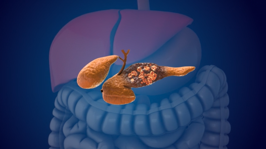 AI Spots Pancreatic Cancer Years Before It Shows Up, Study Finds