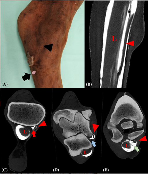 CT tenography for digital flexor tendon sheath