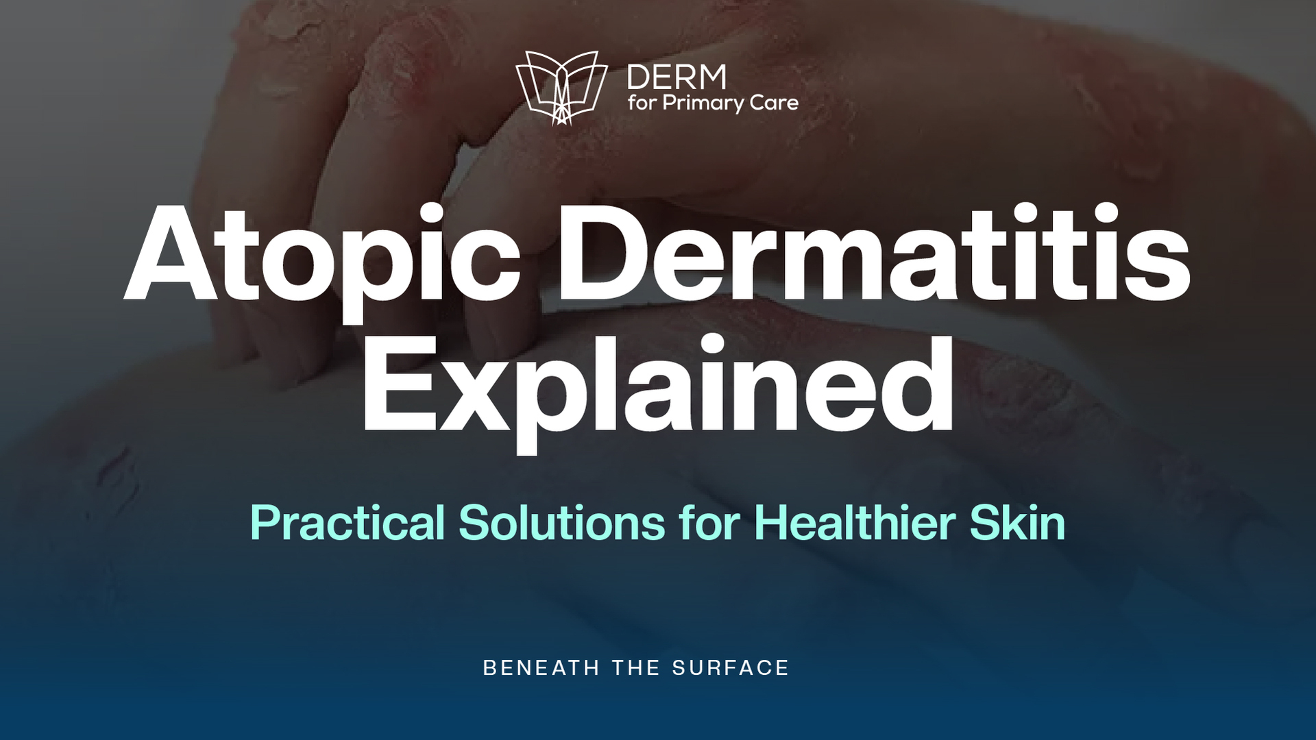 Atopic Dermatitis Uncovered: Effective Solutions & Resources for Better ...